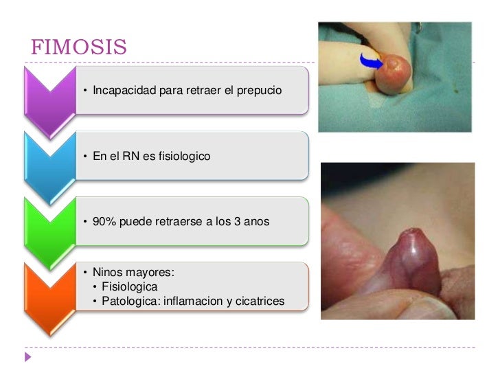 fimosis y parafimosis en nios